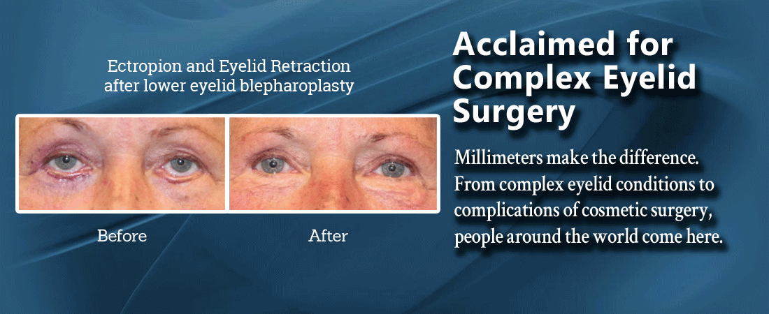 complex eyelid surgery