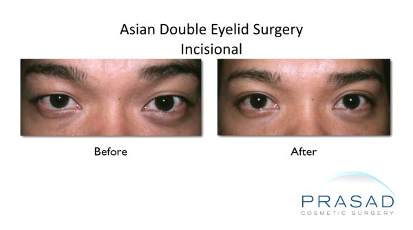 asian eye surgery-Incisional procedure