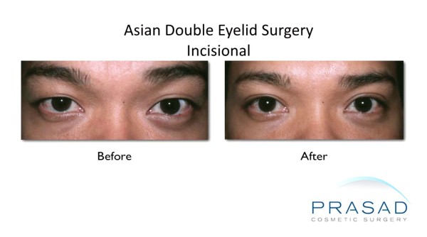 Asian Eyelid Surgery Double Eyelid Surgery Specialist Ny