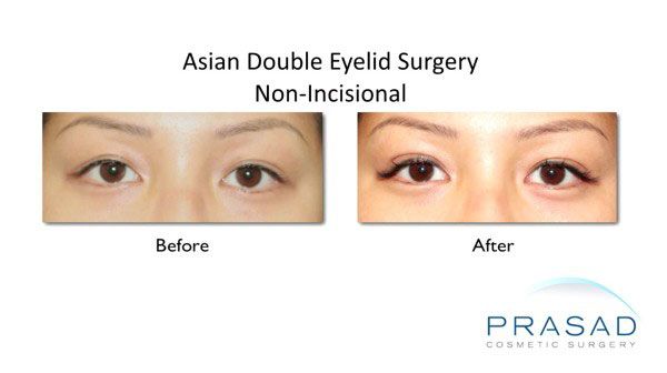 non-incisional double eyelid surgery before and after female