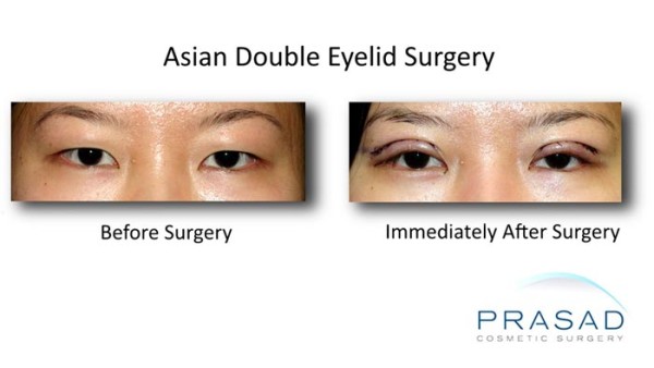 korean double eyelid surgery recovery photo