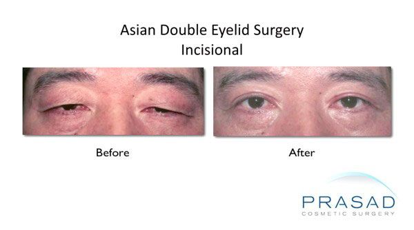 incisional double eyelid surgery male before and after