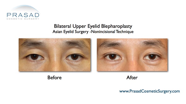 double eyelid surgery male before and after
