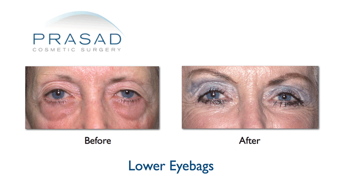 Transconjunctival Blepharoplasty | Eyelid surgery - New York City