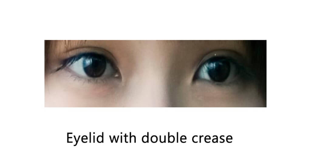 Eyelid with double crease