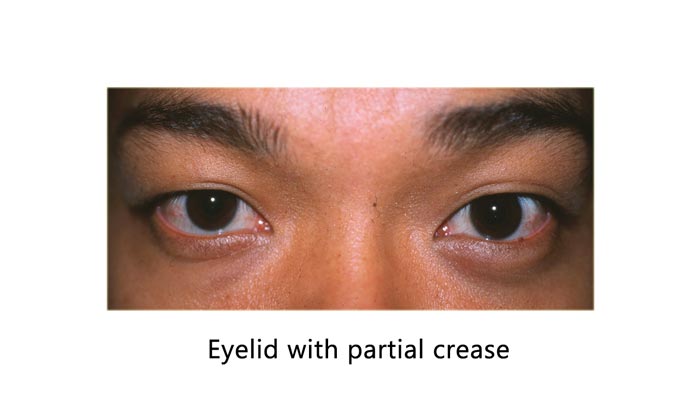 Asian eyelid-partial crease