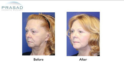 Face and Neck Lift Before and After