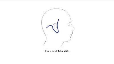 Face and neck lift incision diagram