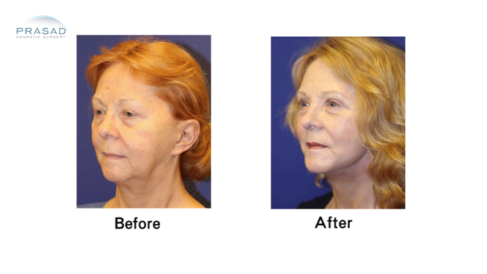 Facelift Patient Before and After
