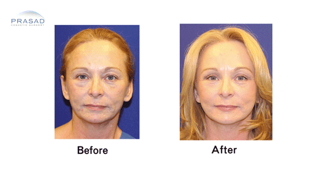 Facelift Patient Before and After