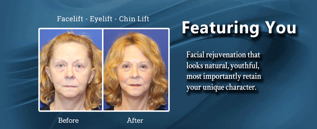 Facelift, Eyelift and Chinlift