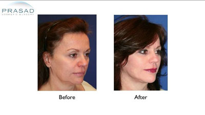 Short Scar Facelift Before and After