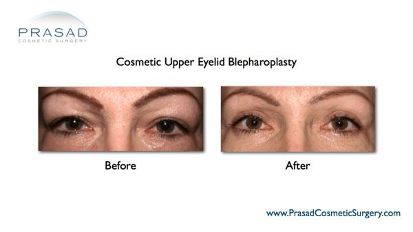 Upper Eyelid surgery-Dr Prasad-New York