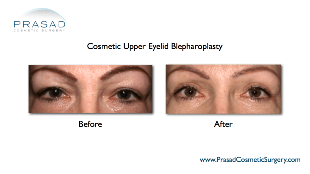 Eyelid Surgery | Upper Eyelid Surgery Procedure and Recovery - NY