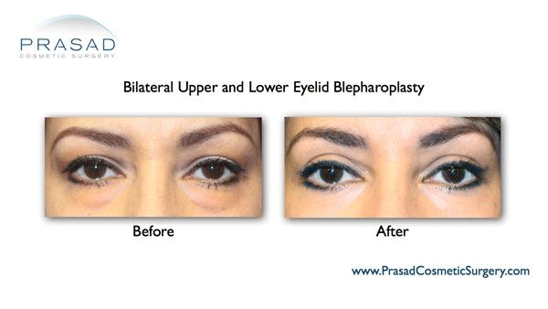 Eye bags surgery-Blepharoplasty