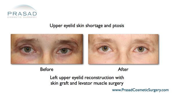 before and after upper eyelid surgery