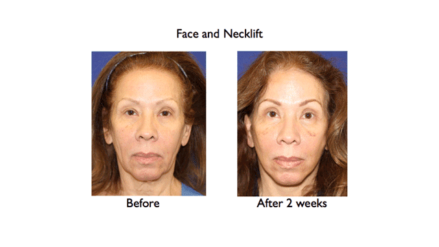 deep plane face and necklift