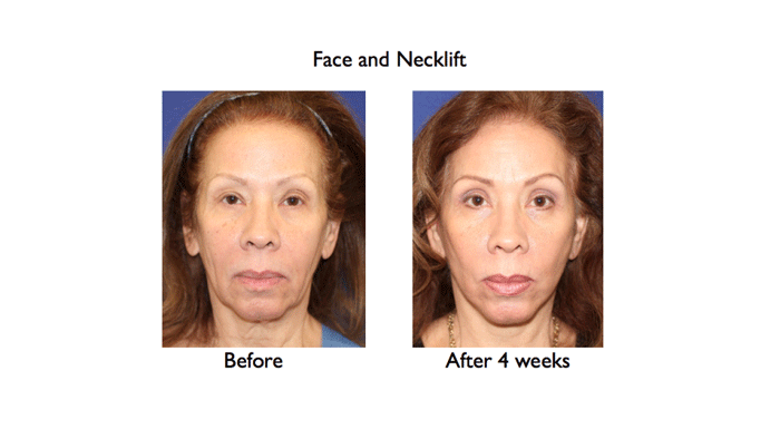 deep plane face and necklift before and after 4 weeks full face