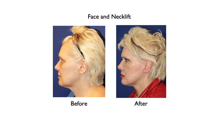 deep plane facelift before and after left profile