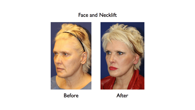 deep plane facelift before and after left three quarters