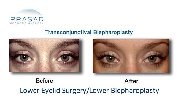 eyelid surgery video