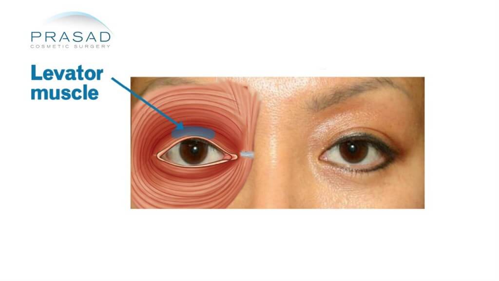 Глазное веко в старину. Леватора верхнего века. Мышца поднимающая верхнее веко птоз. Леватор верхнего века анатомия.