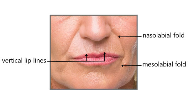 The Best Treatments for Lines around the Mouth  Dr. Prasad's Blog