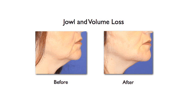 lower face enhancement of mandibular notch and mesolabial fold